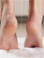 Средство для удаления натоптышей и мозолей PureFeet Keratolytic Intensive IRISK, 30 мл С403-31 - фото 552379